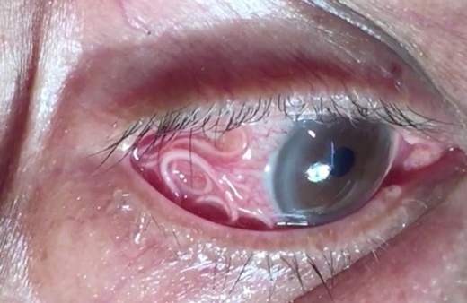 eye 